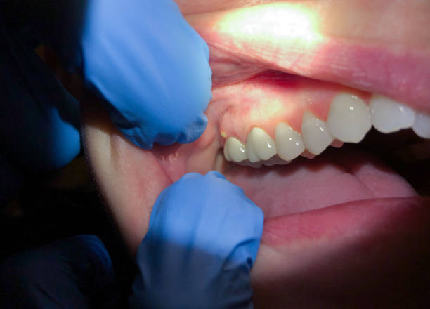 Best Emergency Tooth Extraction in Hominy, OK
